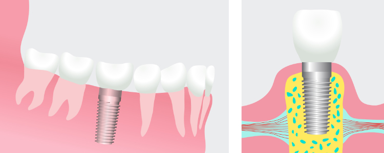 Graphic image of a dental implant with the post on the left and an implant with a dental crown on the right