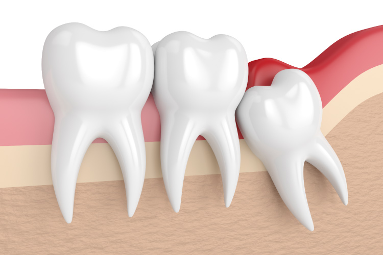 Wisdom tooth in need of extraction by dentists at Helotes Family Dentistry