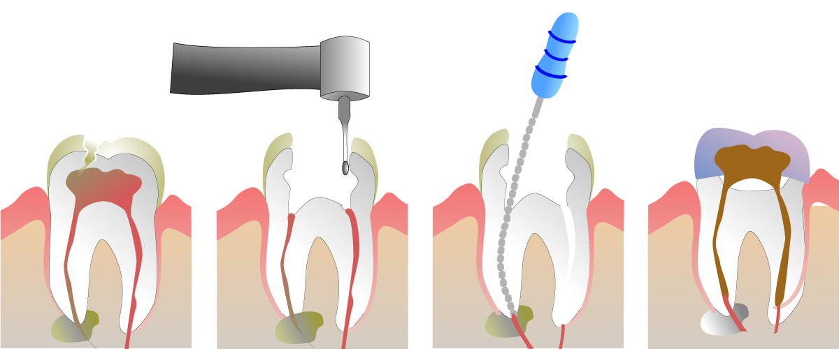 Illustration of the steps to root canal therapy