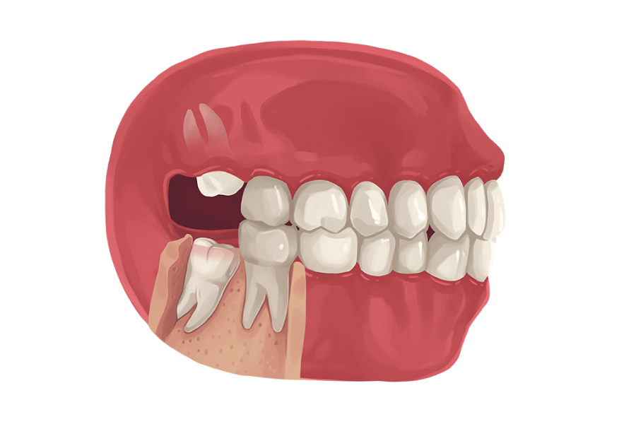 Graphic of a side view of a mouth with wisdom teeth emerging at a bad angle